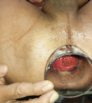 anal soi 3